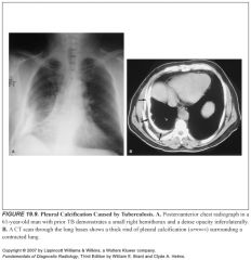 Chapter 19: Pleura, Chest Wall, Diaphragm, & Misc Chest Disorders ...