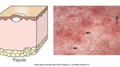 Pathology - Derm. Lesion Etiology Flashcards - Cram.com