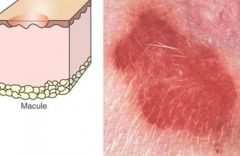 Pathology - Derm. Lesion Etiology Flashcards - Cram.com