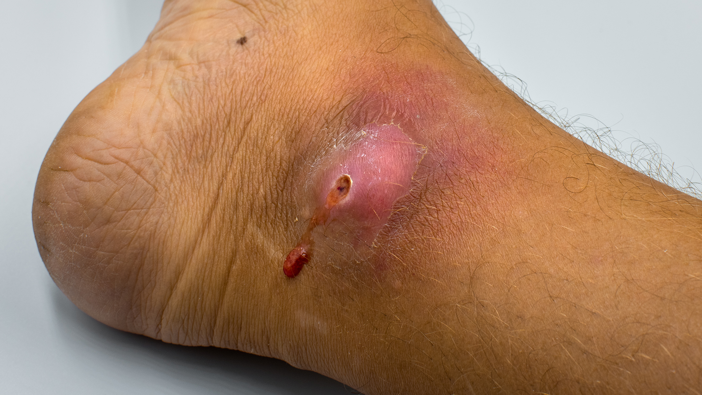 Swollen Wound On Foot Shop | emergencydentistry.com