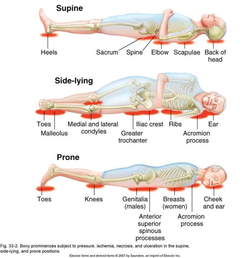 Pressure Ulcer Body Map