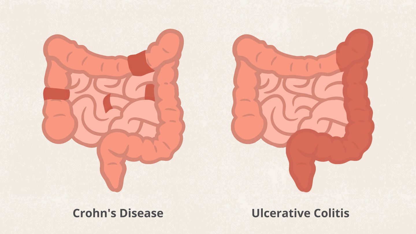 Difference-Between-Crohn's-and-Ulcerative-Colitis-graph-illustration