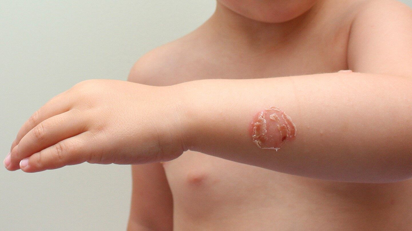 a child with impetigo