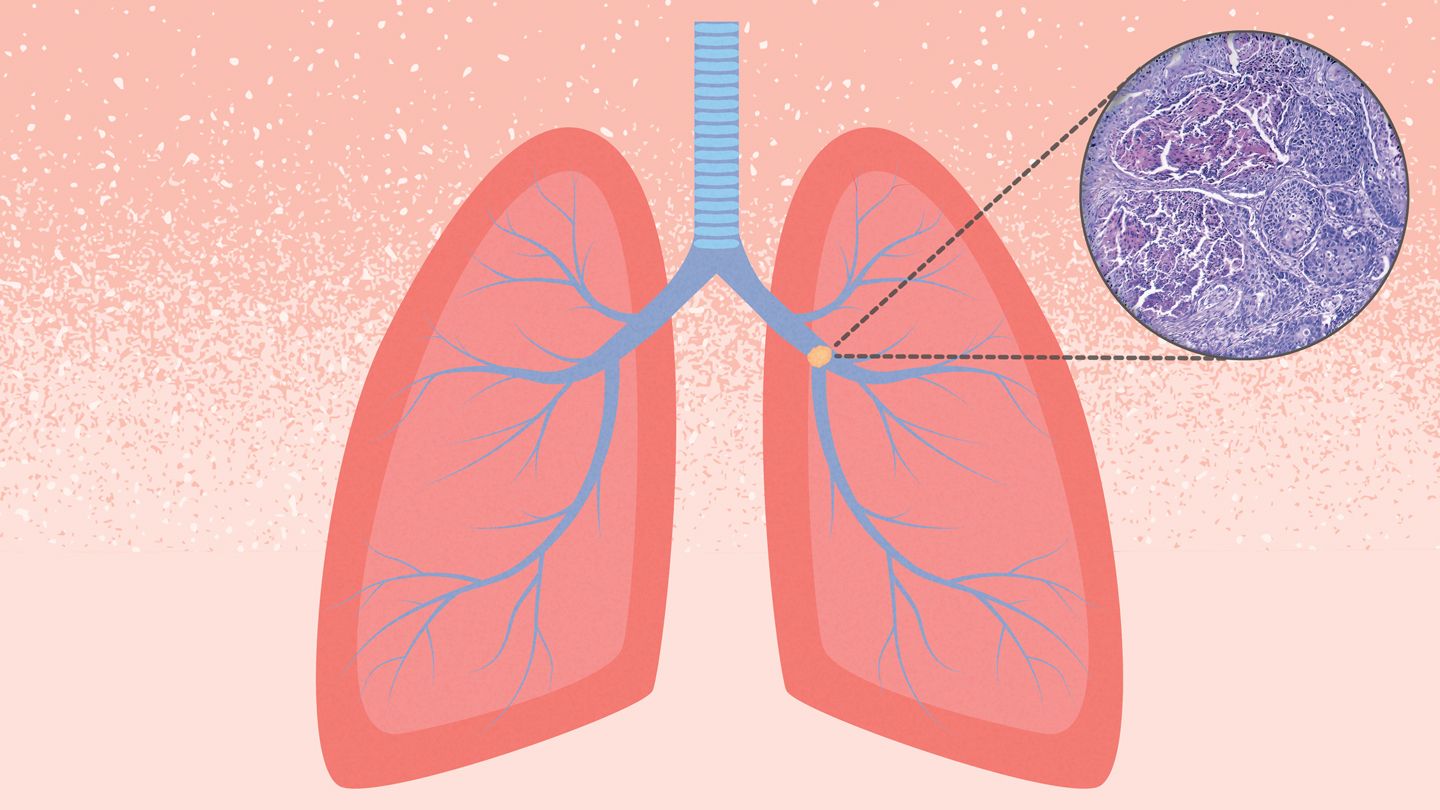 Lung Tumor Diagram