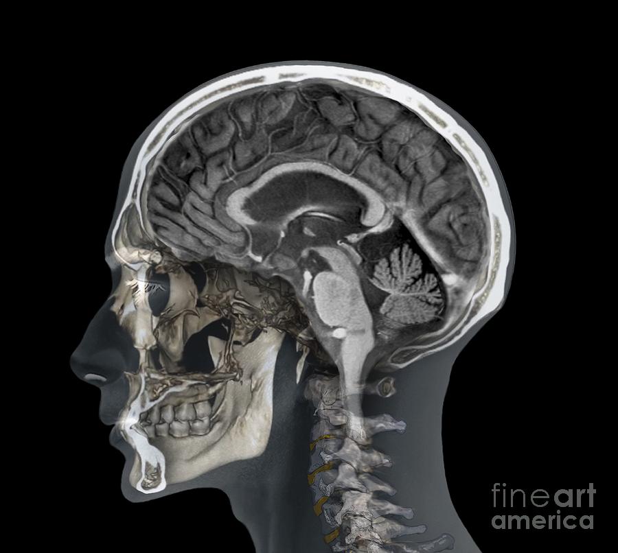 Mri Scan Brain 3d