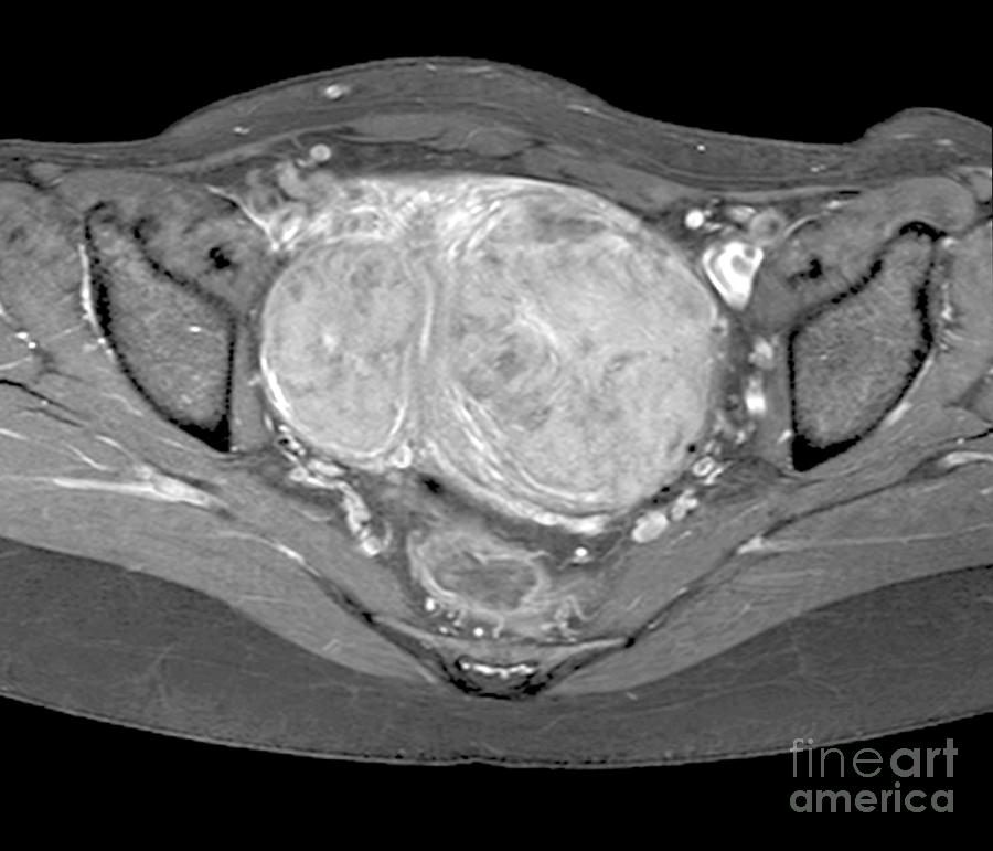 Uterine Fibroids Mri