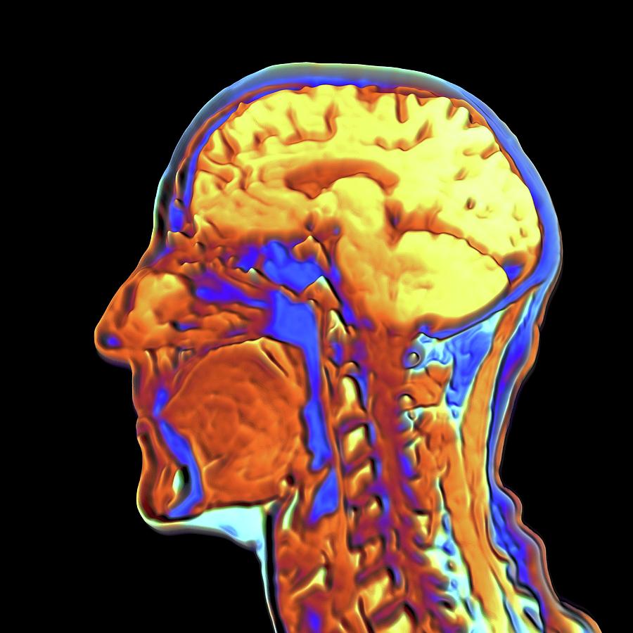 Coloured Mri Scan Of The Human Head #4 by Alfred Pasieka/science Photo ...