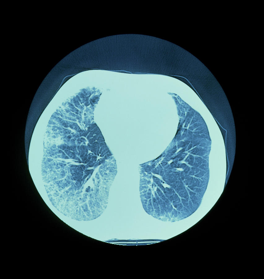 Ct Scan Of Lungs Showing Interstitial Fibrosis Photograph by Science ...