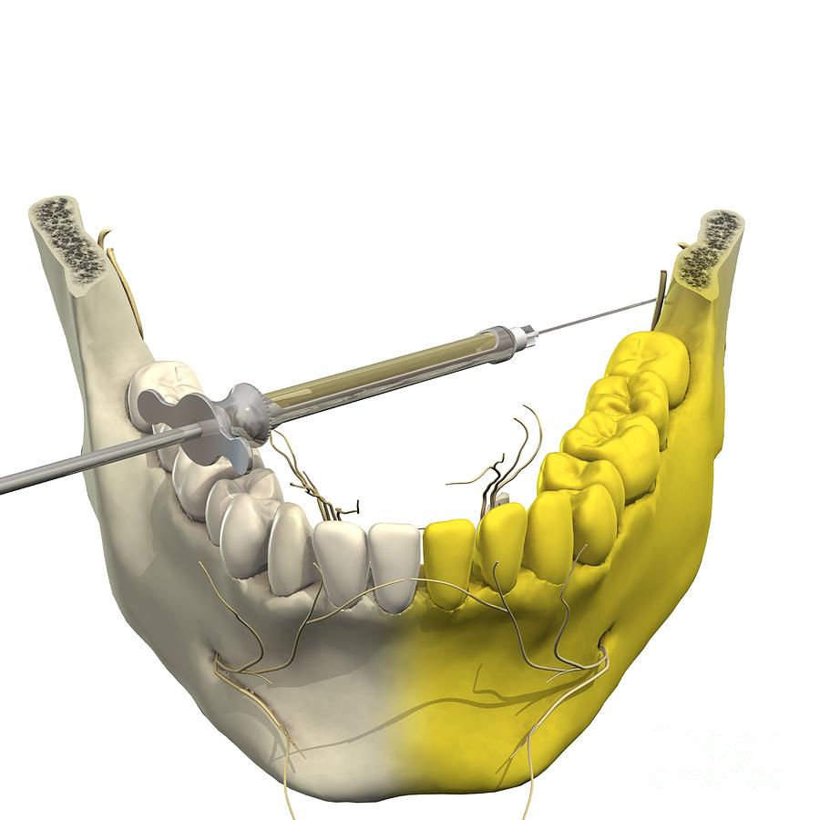 Inferior Alveolar Nerve Block Landmarks | My XXX Hot Girl