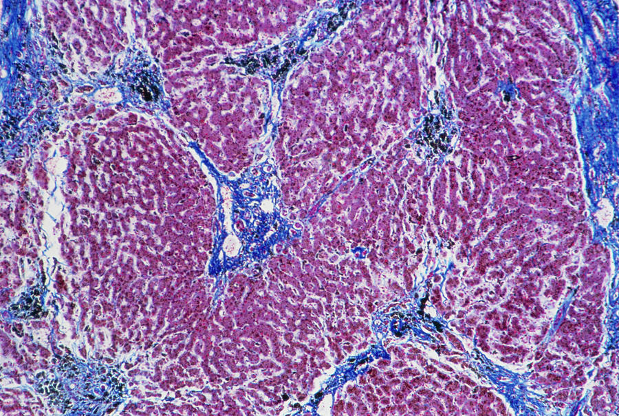 Human Liver Cirrhosis