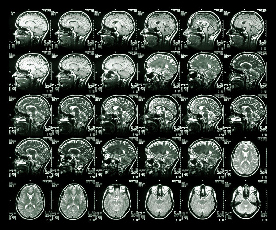 Mri Scans Of A Healthy Human Brain by Simon Fraser/science Photo Library