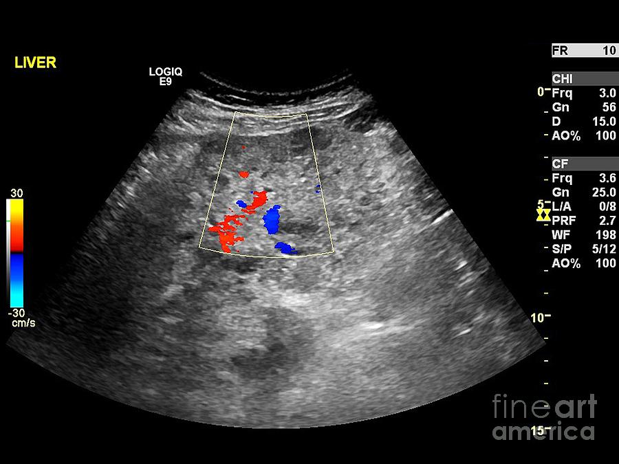 Liver Cancer Ultrasound