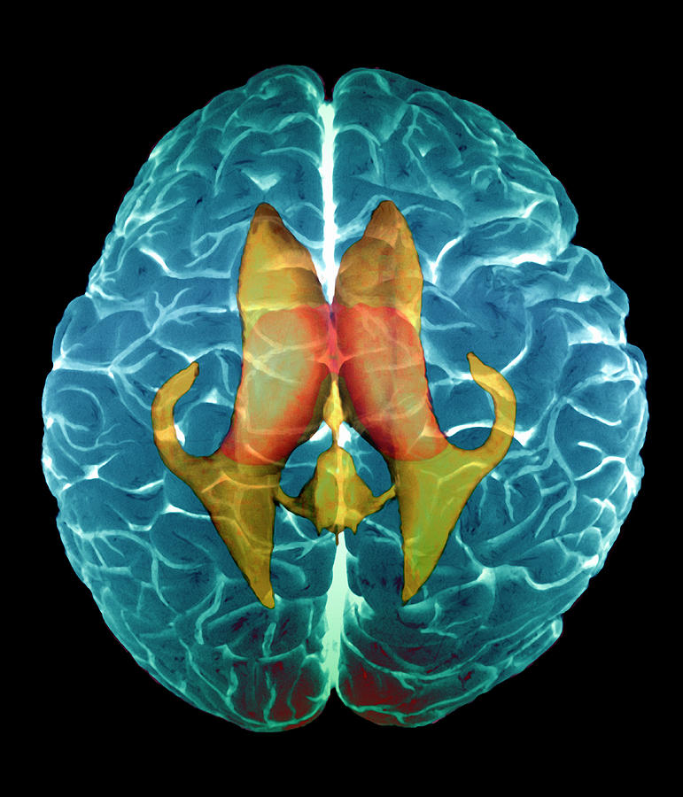 Ventricles Of Brain by Zephyr/science Photo Library