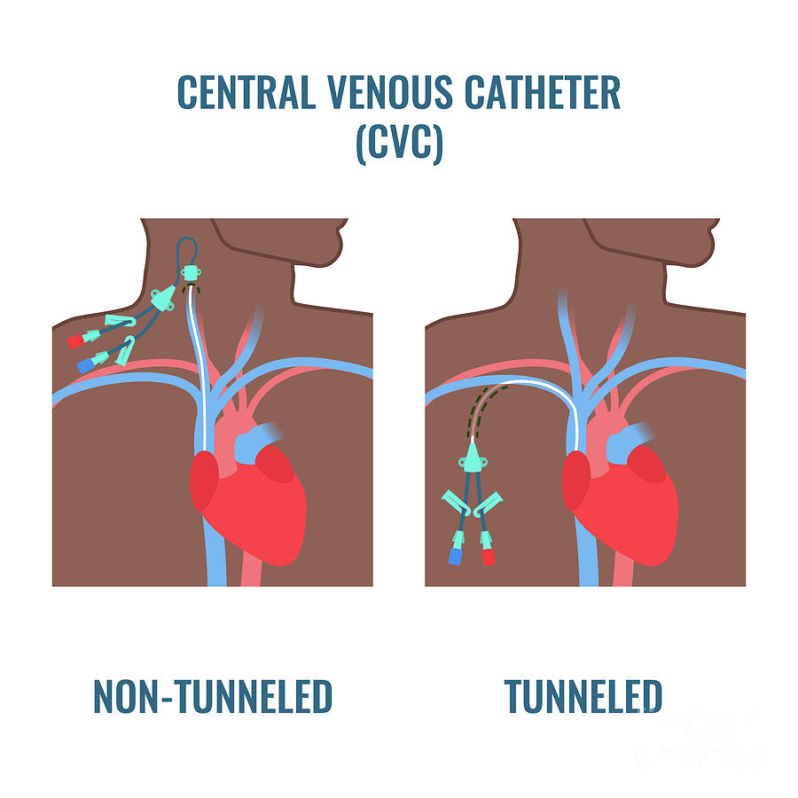 Central Venous Catheter Photograph by Art4stock/science Photo Library ...