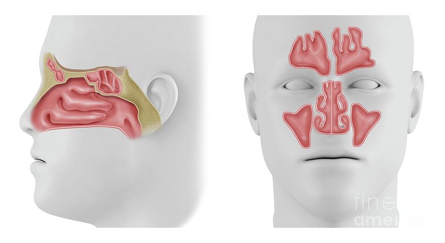 Ethmoid Sinus Polyp | lupon.gov.ph