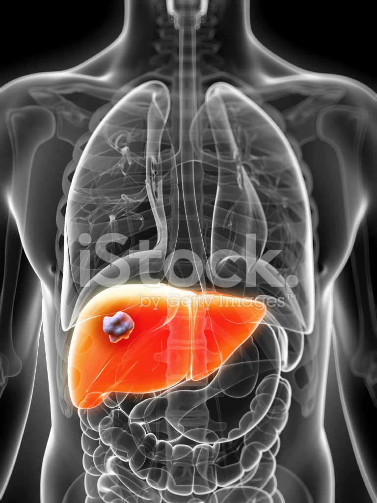 Liver Cancer - Pictures