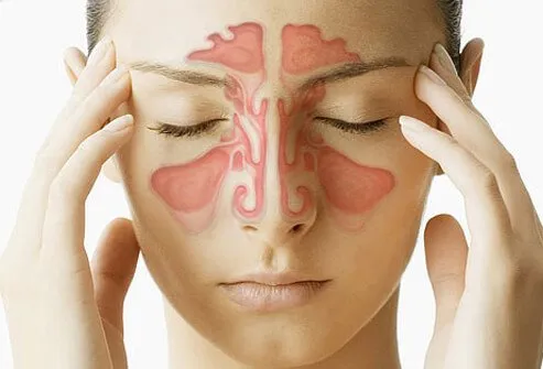 Sinus Infection Sinusitis Symptoms Treatment