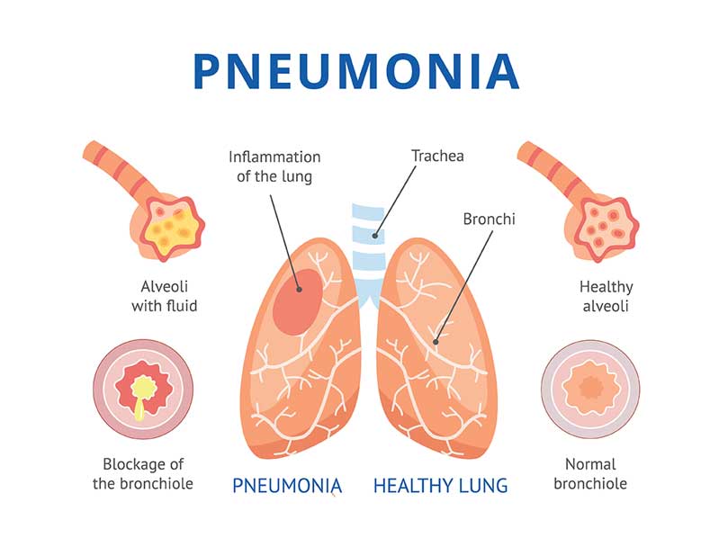 Acute Care Of Pneumonia Patient Case Nursing Essay