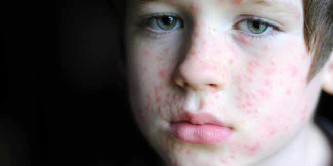 Ways to treat hives on face