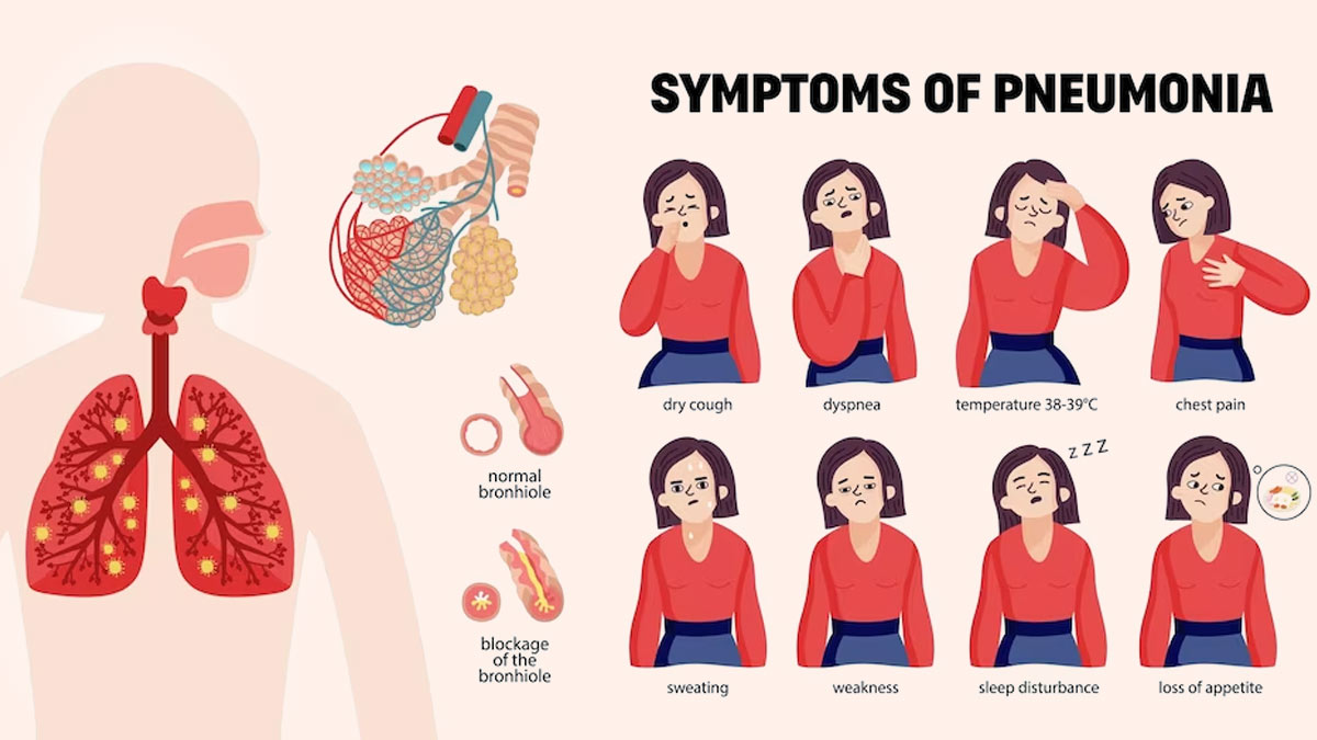 What Causes Pneumonia and How Serious Is It? | OnlyMyHealth