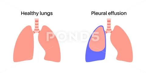 Pleural effusion poster ~ Clip Art ~ Download Now #237892527