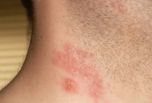 A zoster rash appears on the neck of a patient. 