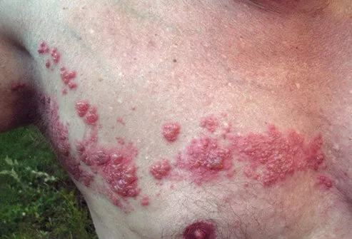 A herpes zoster rash appears on a man's chest and torso. 