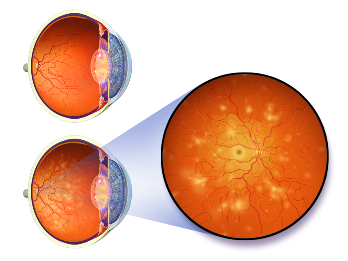 How Does Diabetes Cause Blindness?