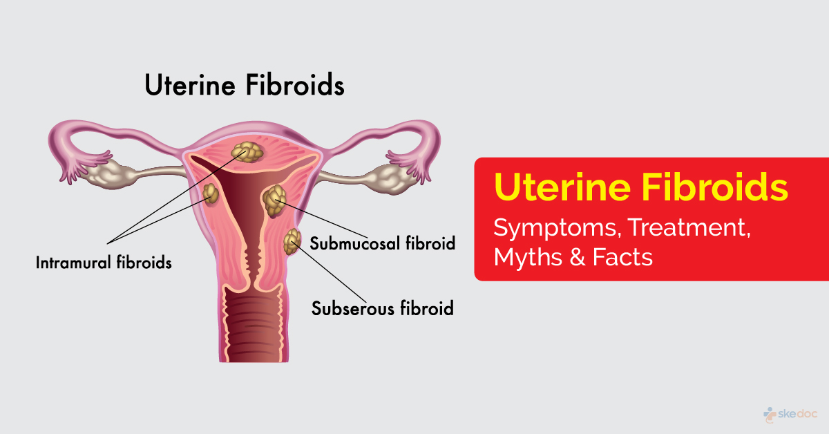 Uterine Fibroid | Causes, Symptoms,Treatment and Diagnosis