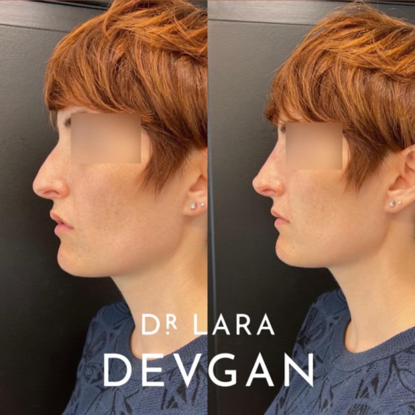 Nonsurgical profile balancing 📐📐📐 My signature approach to nonsurgical rhinoplasty and chin augmentation for harmony of the features. #beautyisinthedetails #facialoptimization #boardcertifiedplasticsurgeon #devganoptimization #nonsurgicalrhinoplas