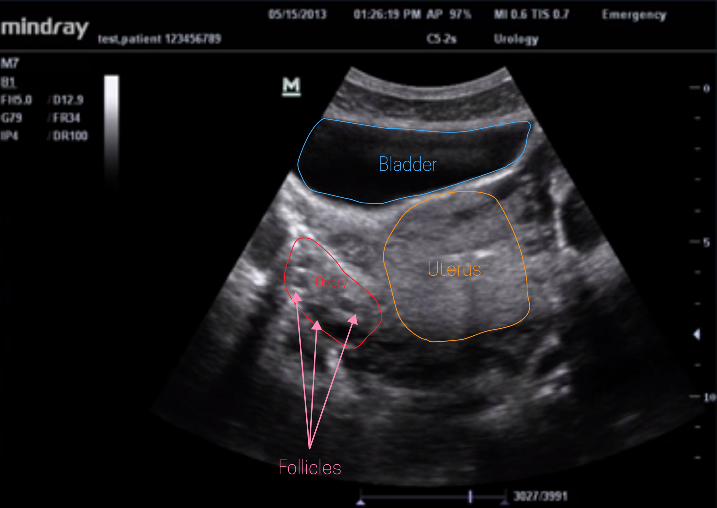 Ovarian Cyst Transabdominal Ultrasound