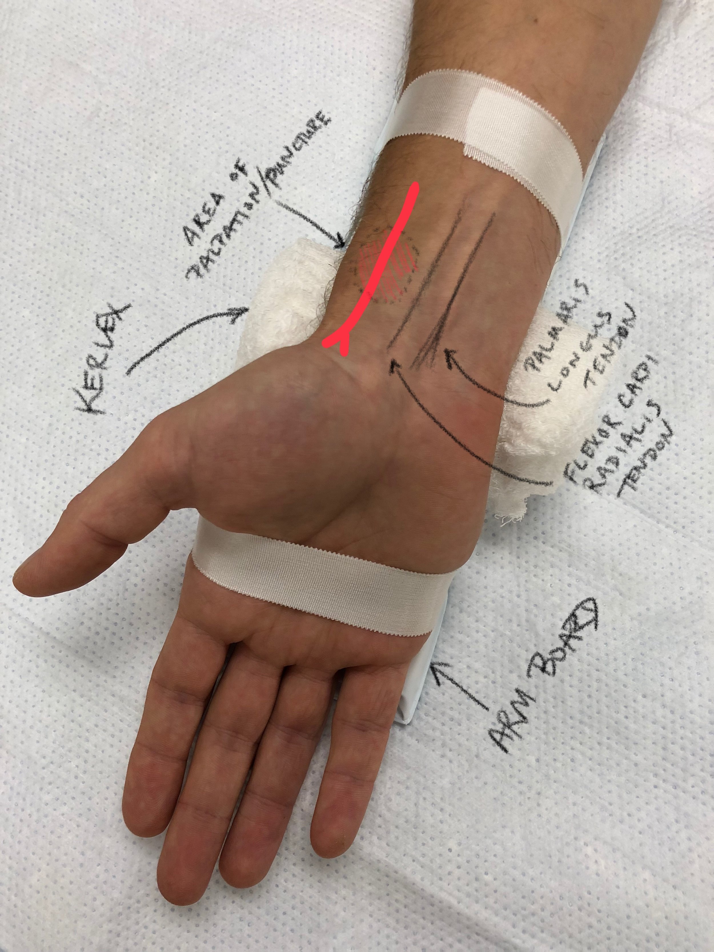 Arterial Line — Taming the SRU