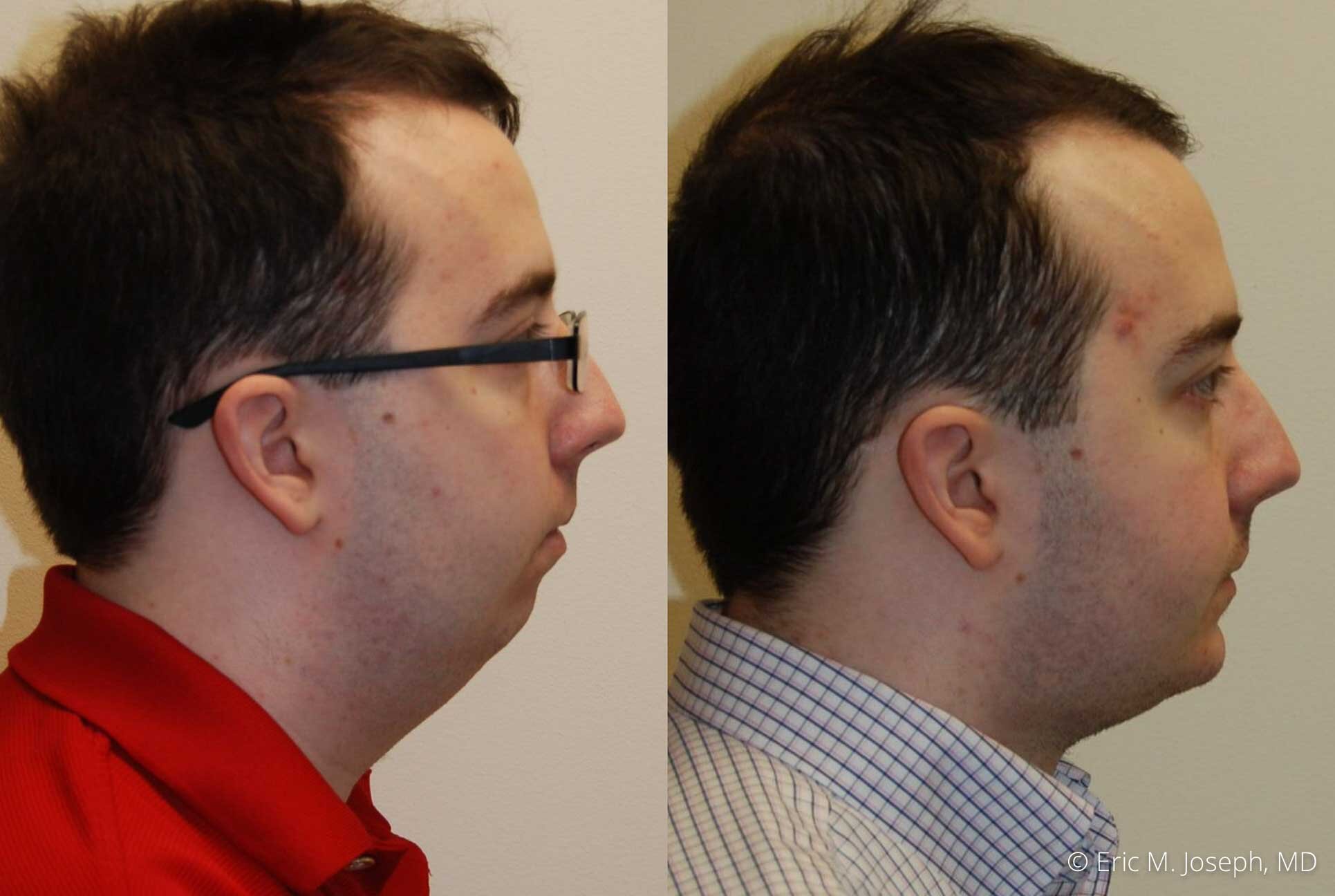 chin-augmentation-nj-nyc-0039.jpg