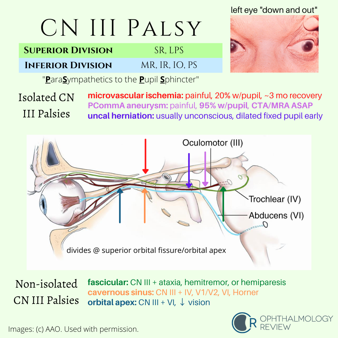 Cranial Nerve Palsy - vrogue.co