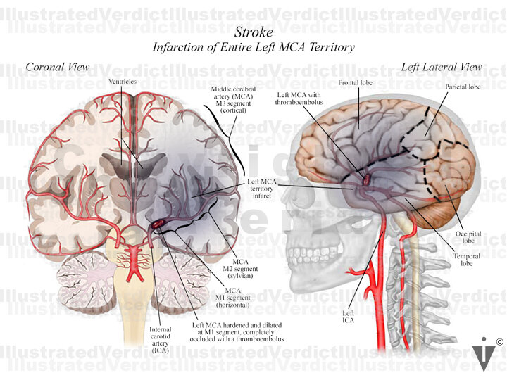 Stock Brain: Stroke — Illustrated Verdict