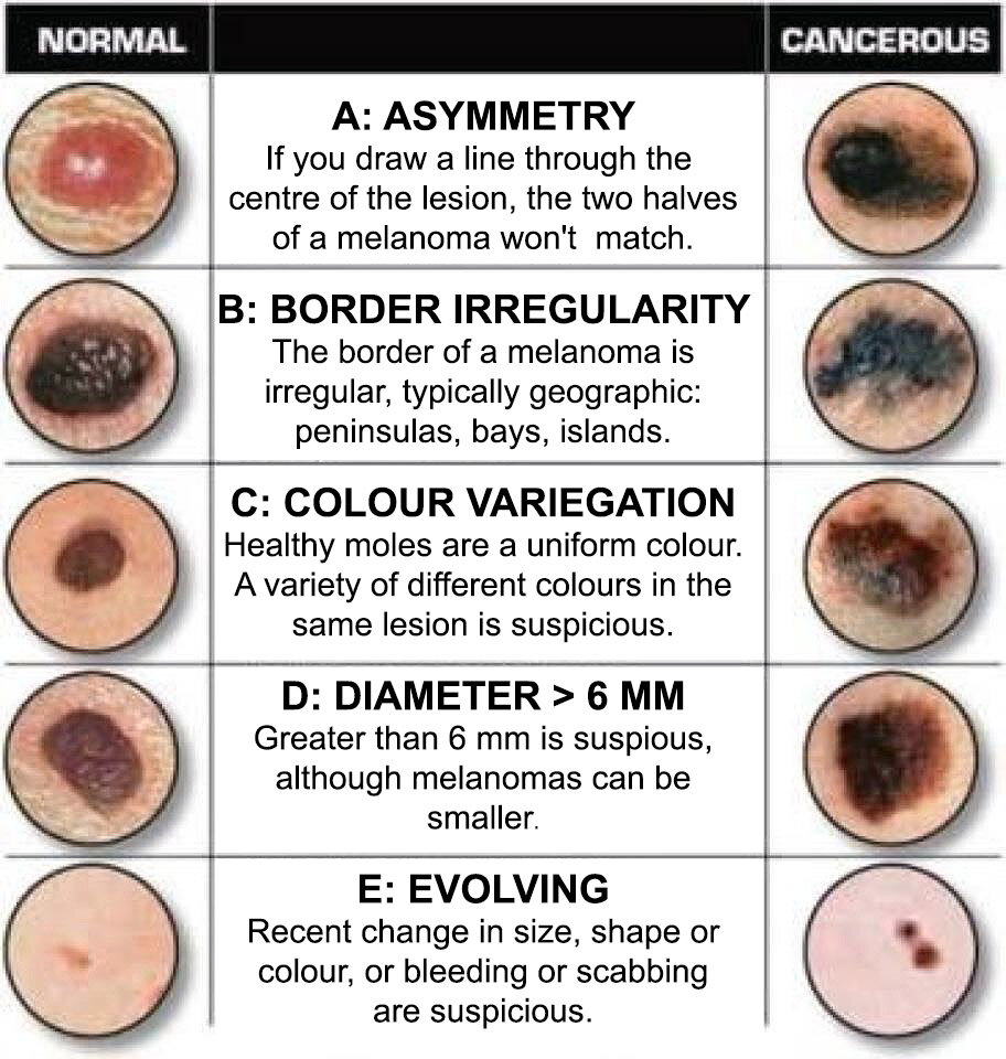 Abcde Melanoma Test Hand Out