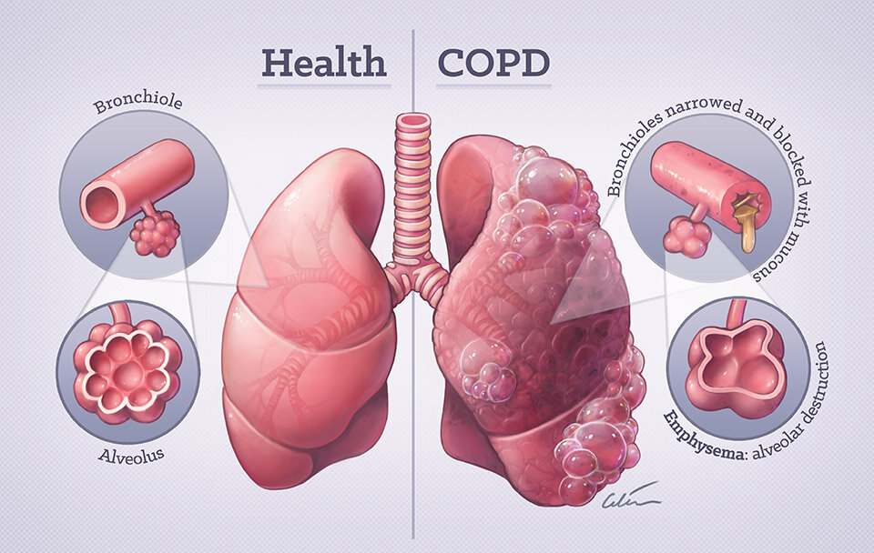 Oxygen For Copd Sale Cheapest, Save 42% | jlcatj.gob.mx