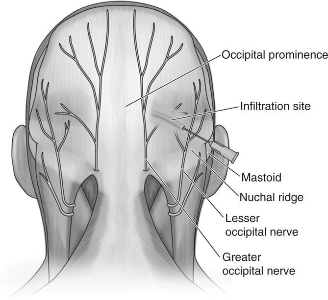 Occipital Nerve Block Injection