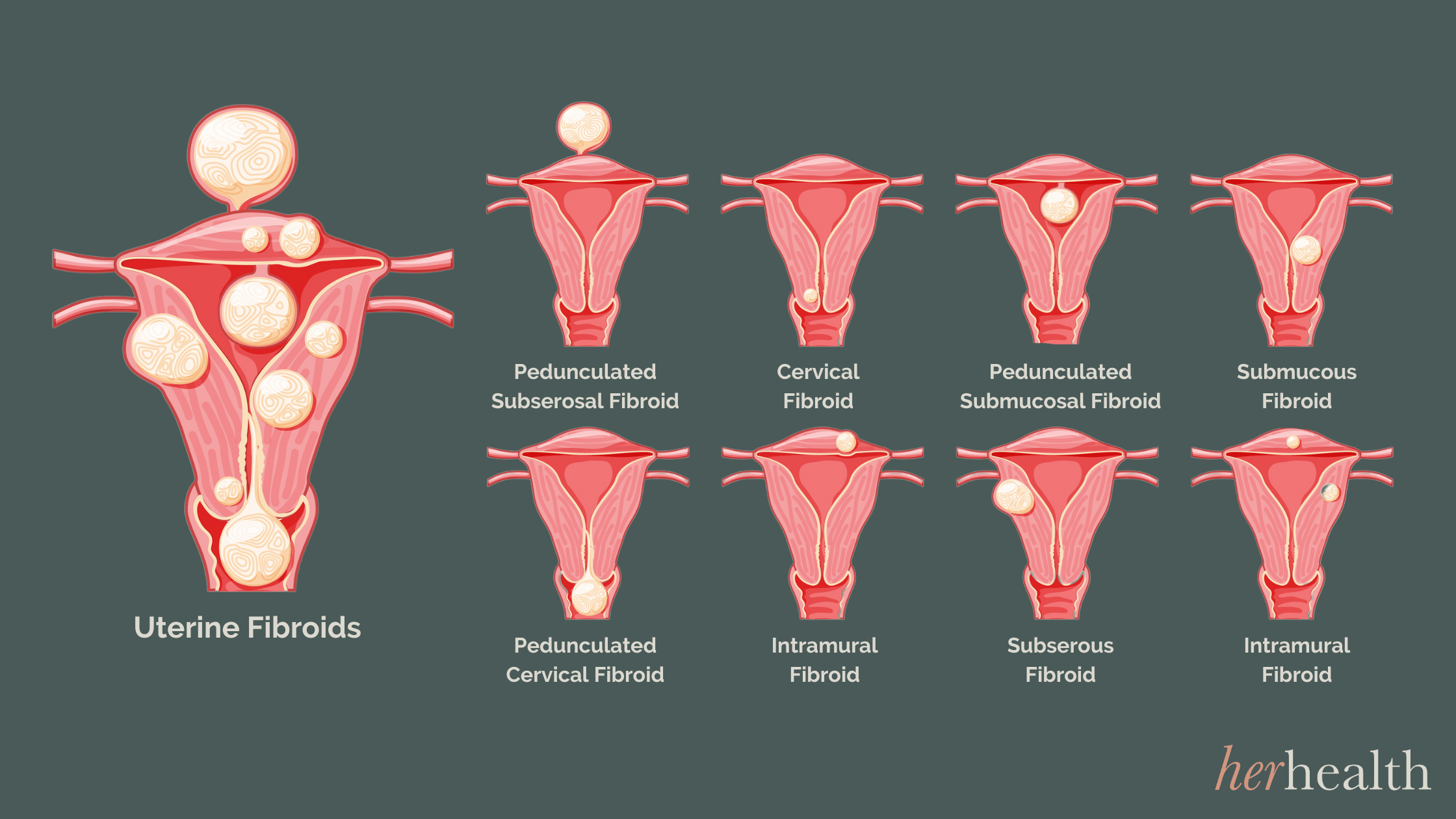 Cramping But No Period: Is It Fibroids?