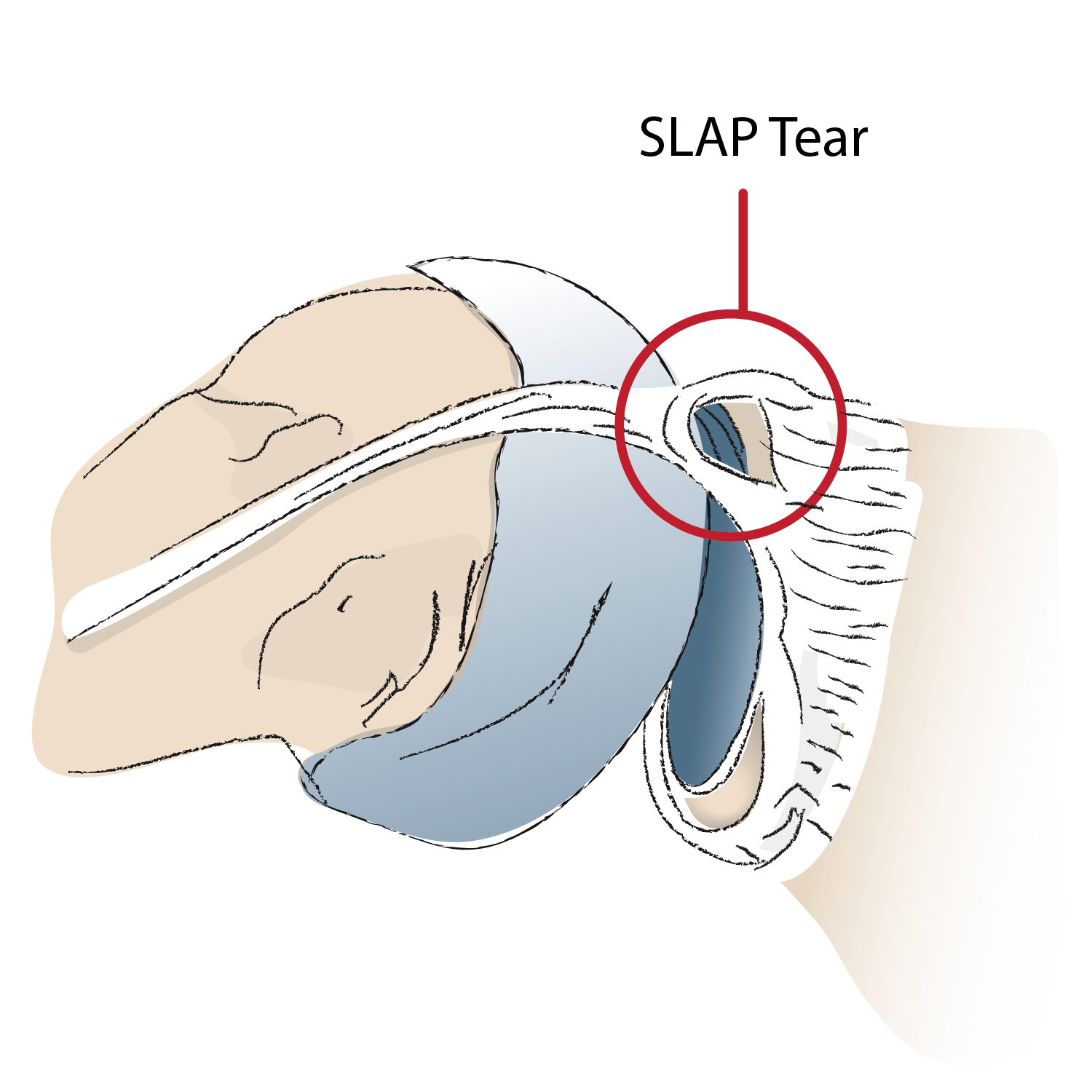 Can You Workout With a SLAP Tear? — Outlast Health and Performance ...