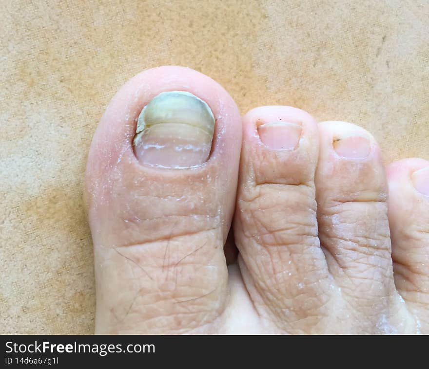 Toe is fungal infection.Medical, treatment, health and medicine concept.Dermatologist,background.