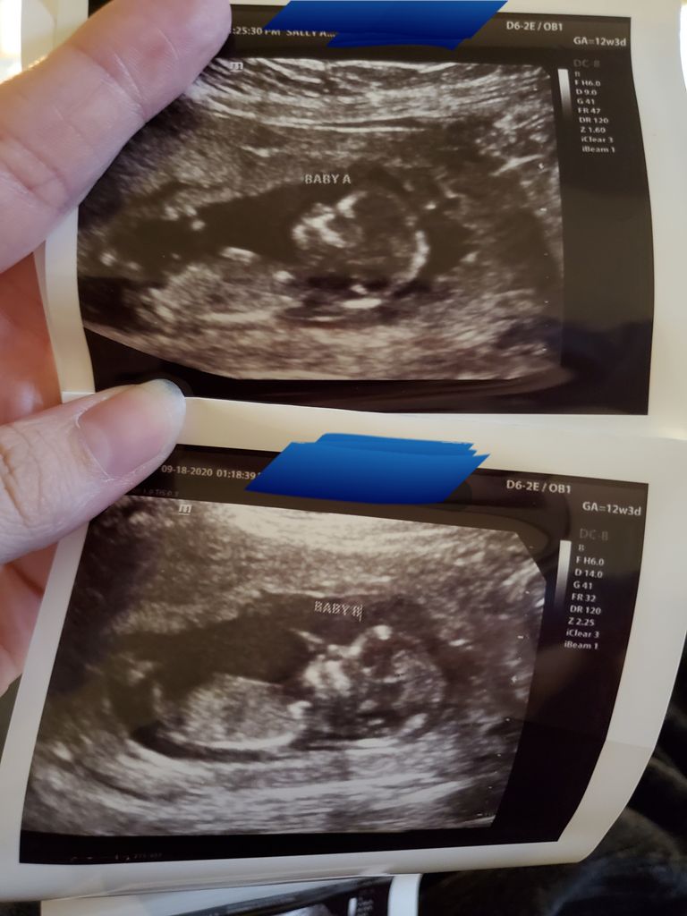 Ultrasound Pictures Of Identical Twins