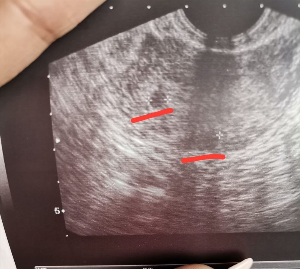 Twin Weeks Pregnant Ultrasound Selling | micoope.com.gt