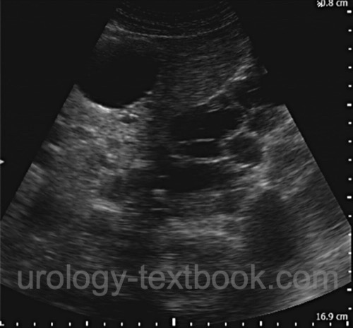 Autosomal Dominant Polycystic Kidney Disease (ADPKD)