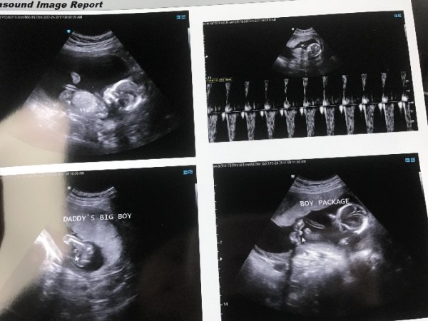 Early Gender Ultrasound - Page 2 - BabyCenter