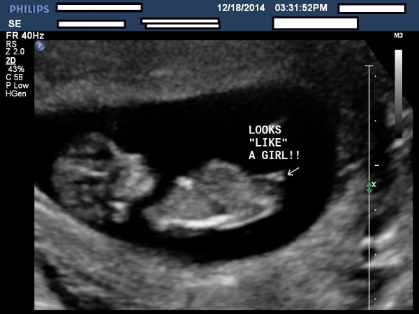 12 Week Ultrasound Pictures Gender