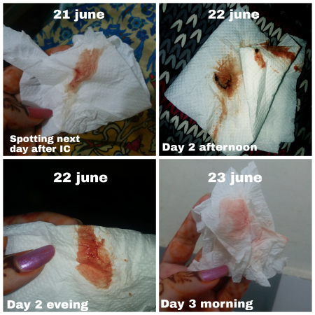 Implantation Bleeding Examples