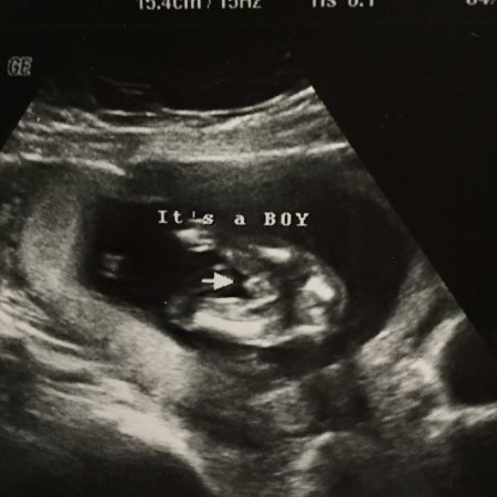 15 Week Gender Ultrasound