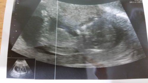 Three lines......girl? 12 weeks 6 days ultrasound pics - BabyCenter