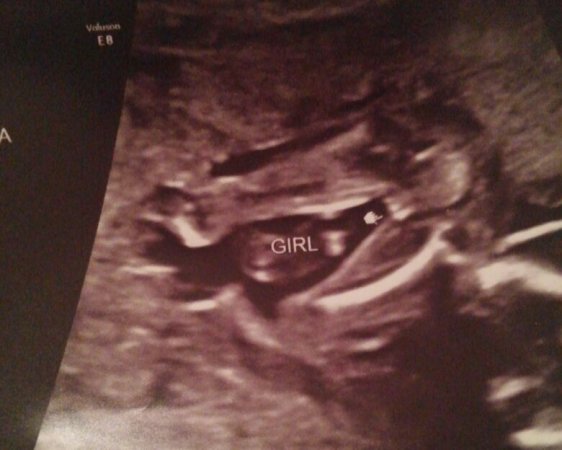 16 Week Twin Ultrasound